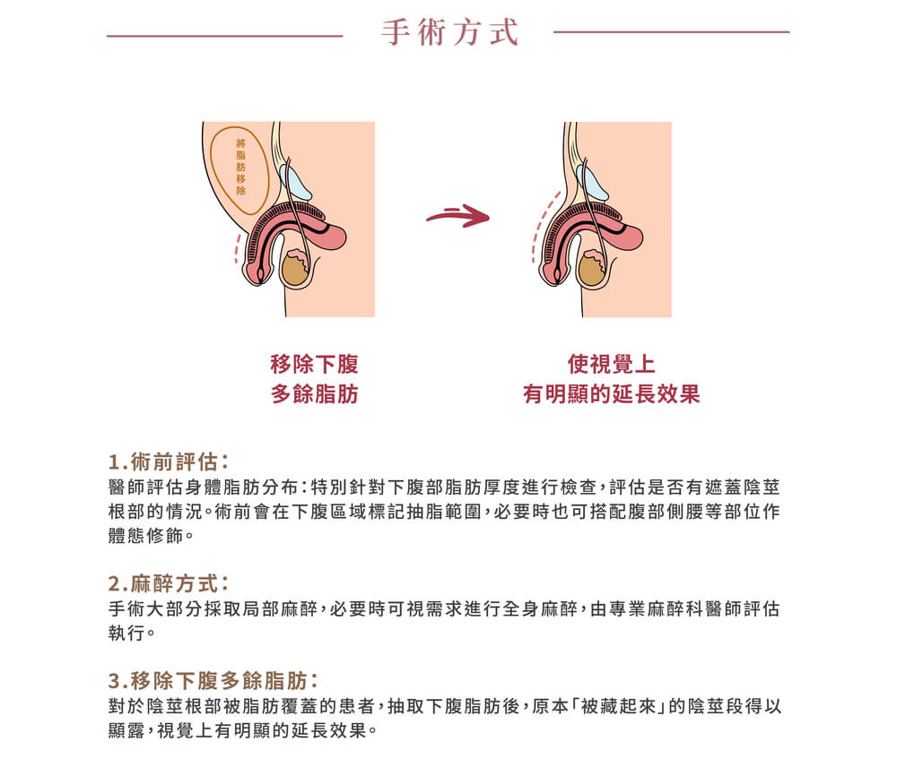 男性下腹抽脂術